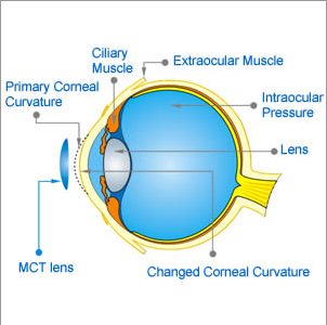 MCT Technology Orthokeratology Lens Brings better vision：For pathological myopia/MCT-H/High-end MCT Technology/MCT Technology Orthokeratology Lens Pathological Myopia Needs Early Prevention (MCT Technology Orthokeratology Lens)