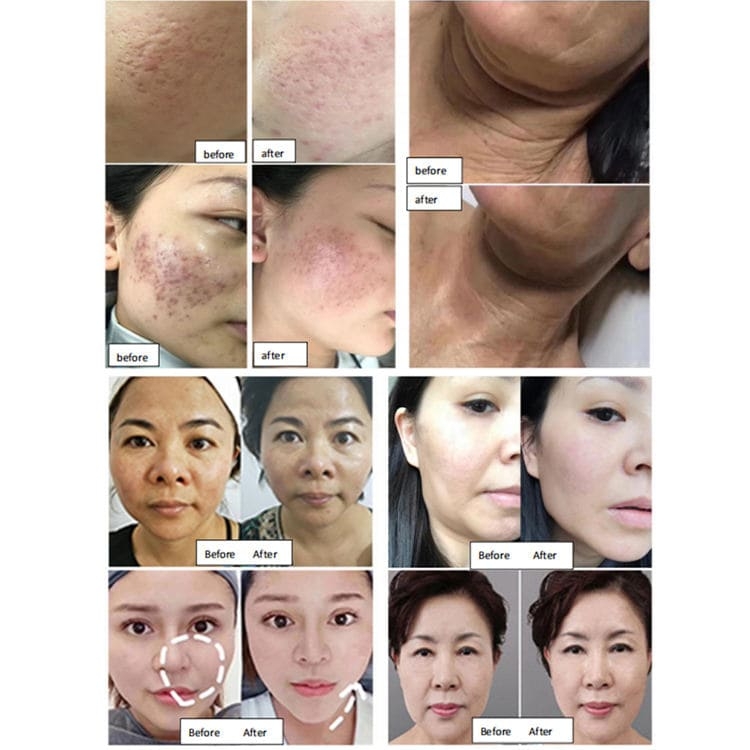 6 In 1 Professional And Rf Microneedling Hifu 7d Ultramax Face Lift Machine For Face And Body  