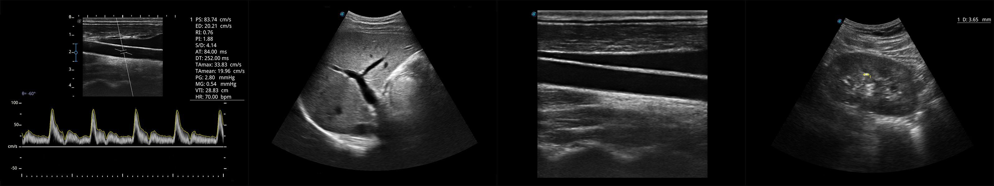 SonoScape E1 Portable Ultrasound System - Front view showcasing high-resolution color Doppler imaging.
