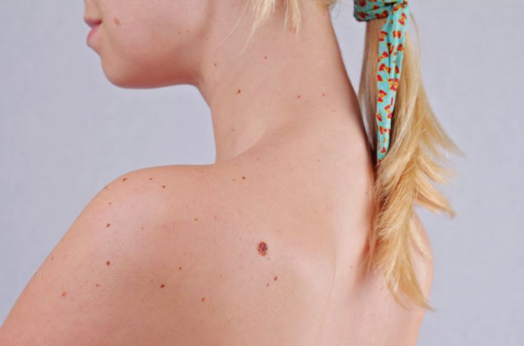 Wrong Ways to Removing Moles and Skin Tags at Home