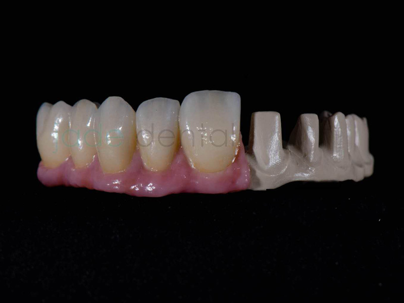 peek material in dentistry