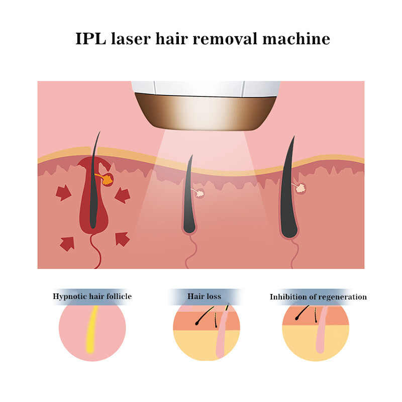 Home use IPL Laser Hair Removal