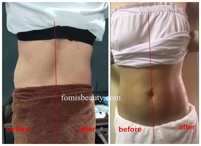 2 in 1 RET rf slimming Vacuum weight loss