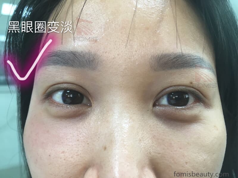 wrinkle removal anti-aging bio lifting machine