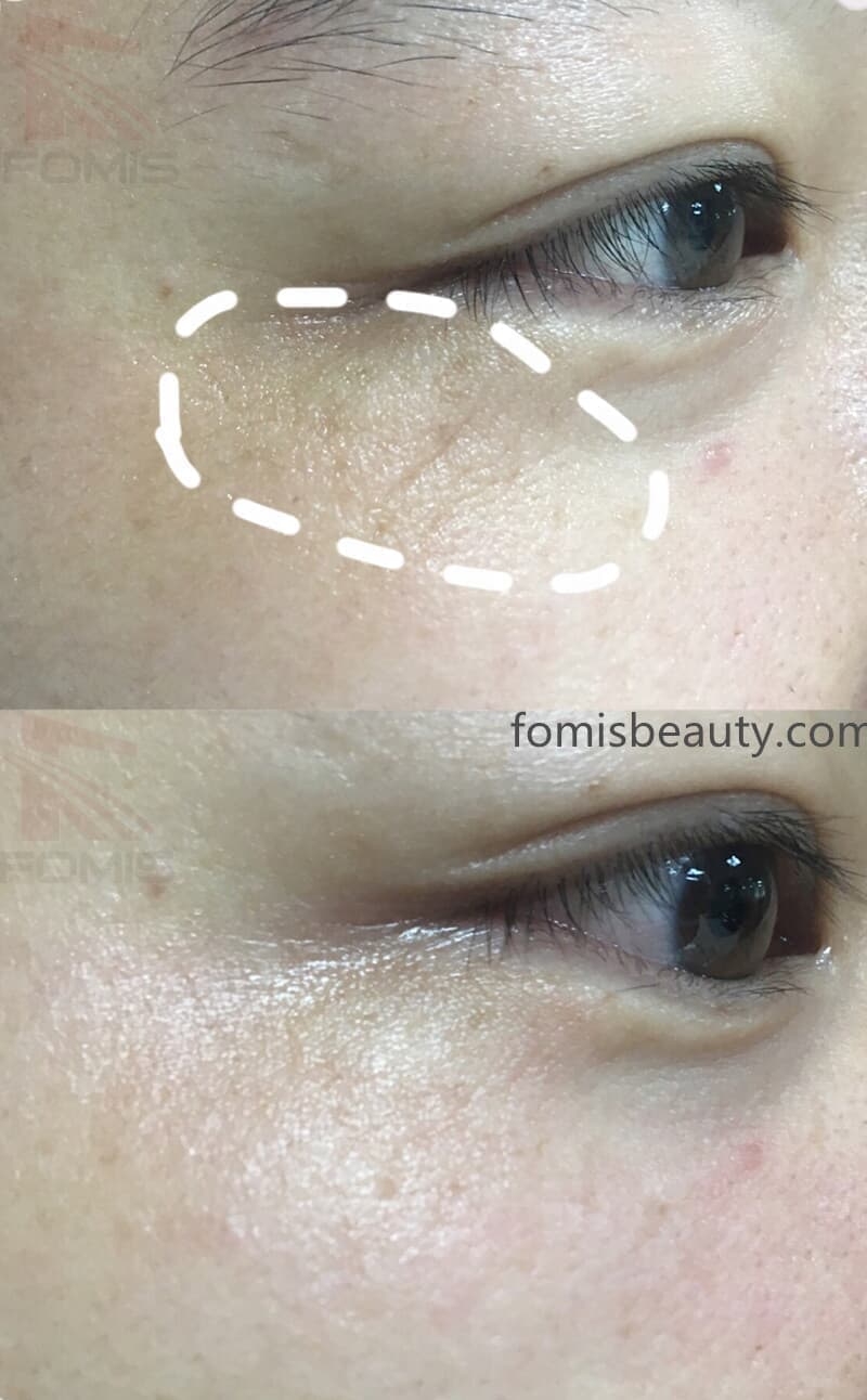 wrinkle removal anti-aging bio lifting machine