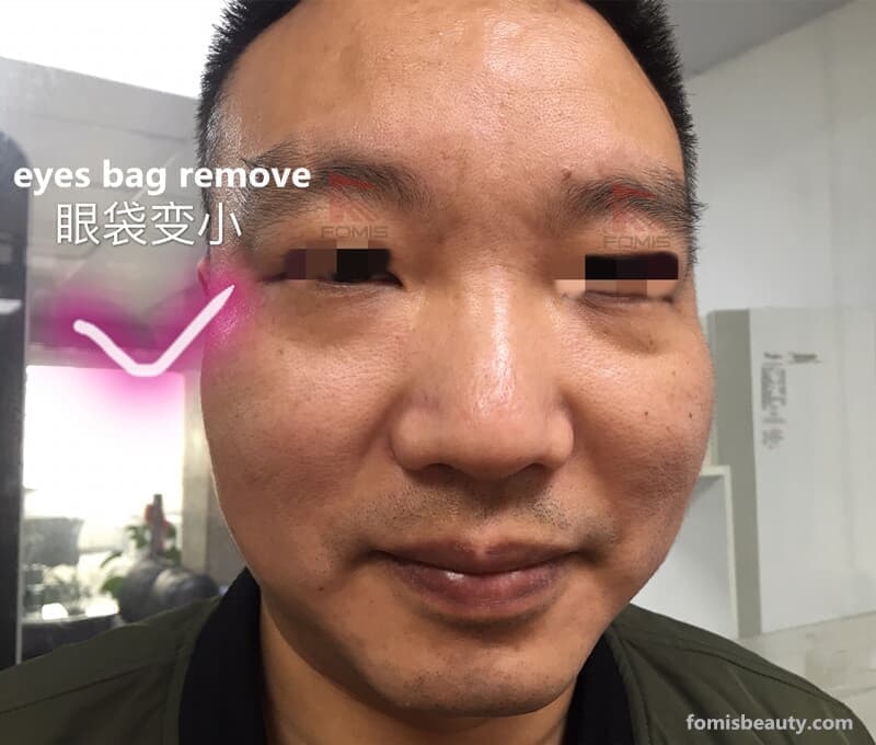 wrinkle removal anti-aging bio lifting machine