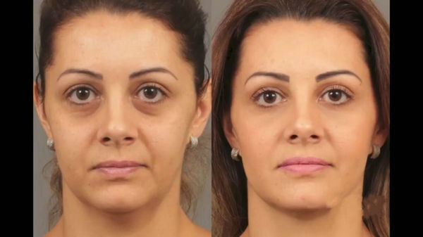 Korea Neuramis dermal filler with Lidocaine
