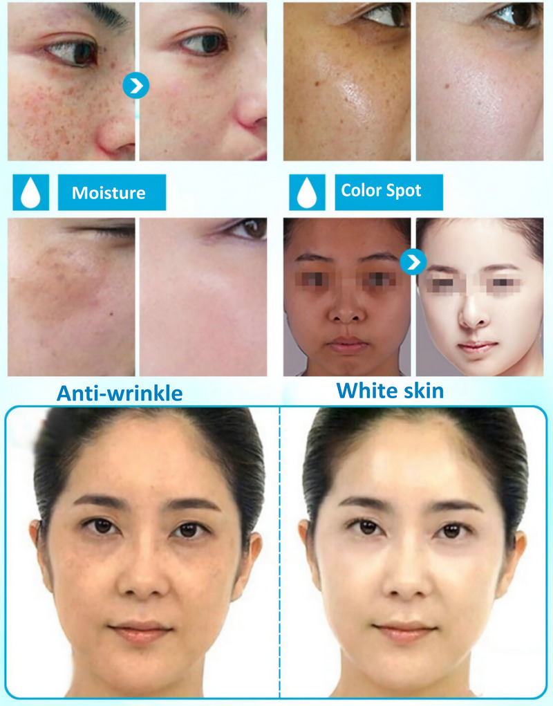 Korea mesotherapy Rejuran sodium hyaluronate injection